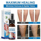 Spray tratamiento para Varices y Arañitas