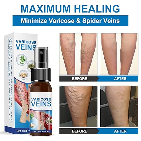 Spray tratamiento para Varices y Arañitas