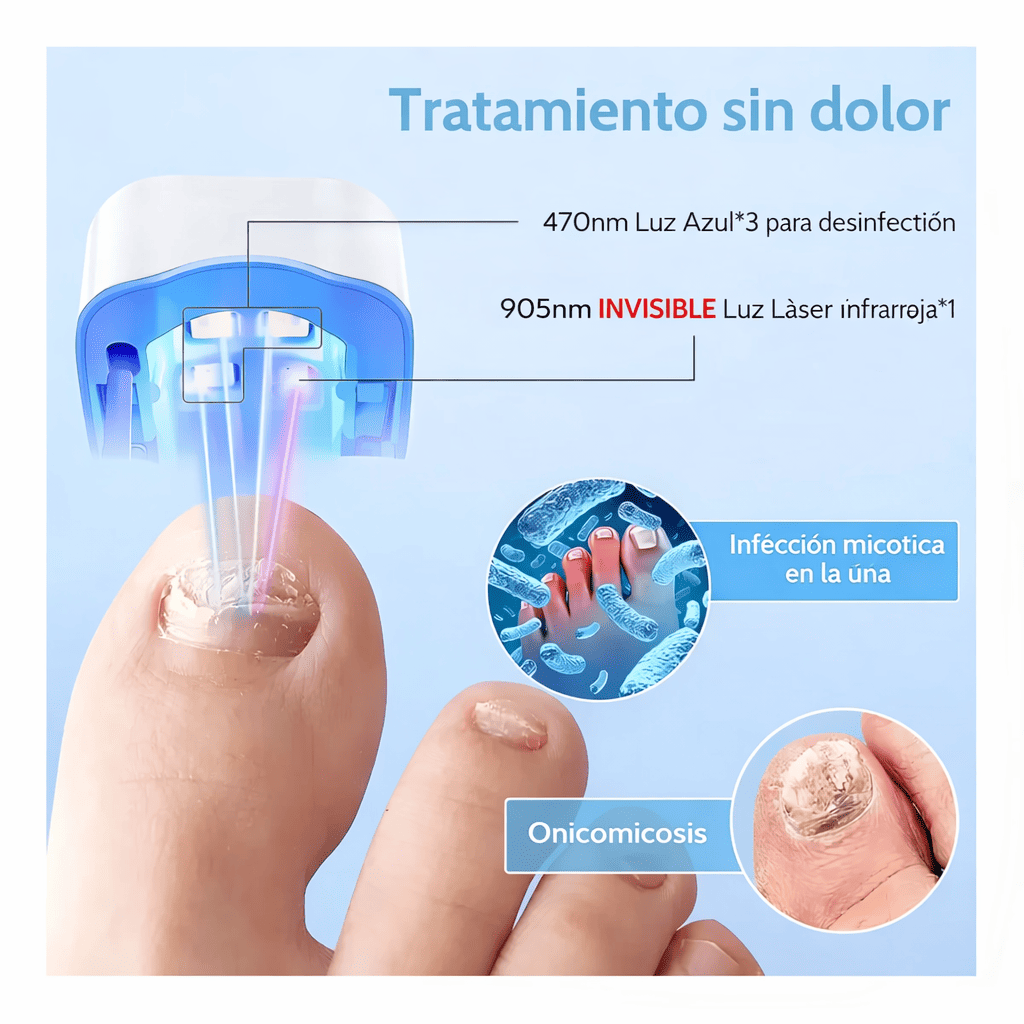 UñaSana – Tratamiento Láser Portátil